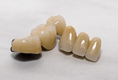Tooth-colored fixed bridges prior to placement