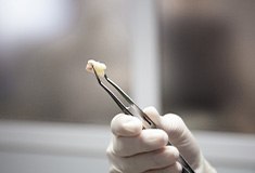 Dentist holding and extracted tooth