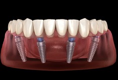 All-on-4 Dental Implants