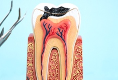 model of an infected tooth