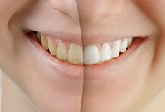 Teeth half before and half after teeth whitening