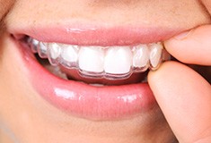 Closeup of patient placing Invisalign tray