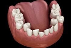 Digital illustration of a lower jaw with crowded teeth in Forest