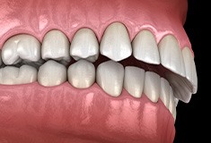 Digital illustration of a mouth with overbite in Forest