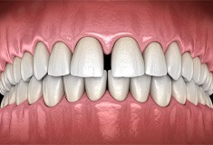 Digital illustration of mouth with gap between two front teeth in Forest