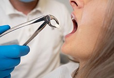 Profile view of extracted tooth being pulled away from woman’s mouth