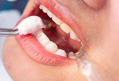Closeup of fluoride foam being applied to someone’s teeth