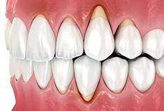 Illustration of gum recession