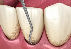 Illustration of scaling and root planing