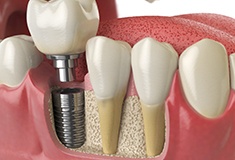 A 3D illustration of a dental implant alongside healthy teeth