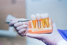 Dentist pointing to model of dental implant