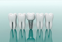 Model dental implant in Forest next to model teeth for comparison 