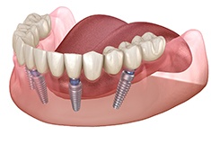 Digital illustration of all-on-4 implant dentures in Forest