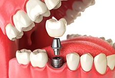 Digital diagram showing dental implants in Forest being placed