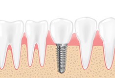 Digital illustration showing dental implants in Forest during osseointegration