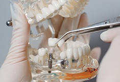 Dentist placing model dental implant in Forest on model jaw