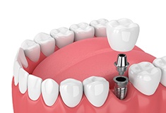 Digital illustration of single tooth dental implant in Forest