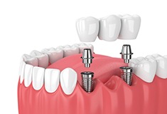 Digital illustration of implant bridge replacing multiple missing teeth in Forest