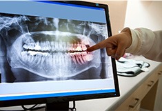 Panoramic dental x-rays on computer