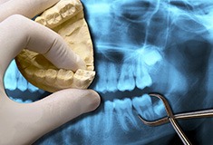 Model smie and x-rays of tooth to be removed