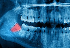 X-ray of impacted wisdom tooth