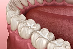 An Illustration of dental sealants 