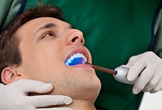 Dentist in Forest applying dental sealants to a patient's teeth 