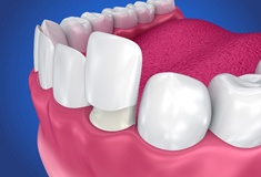 model of porcelain veneers fitting over teeth