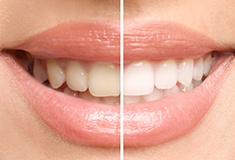 Before and after of teeth whitening