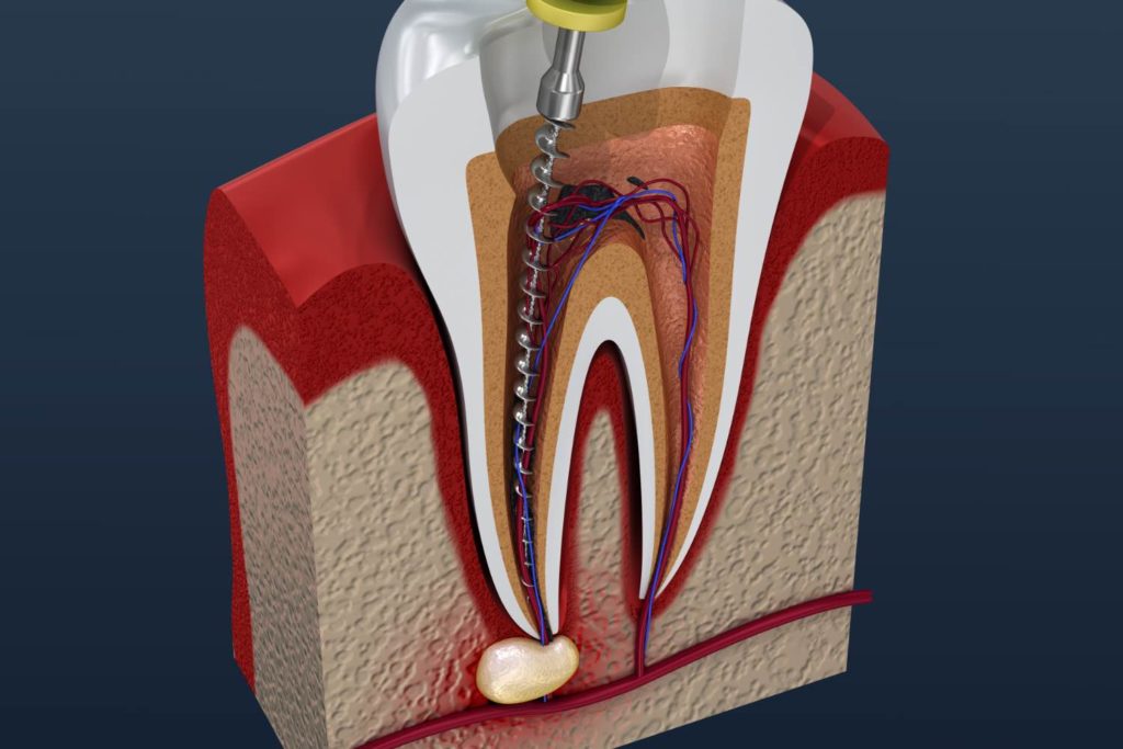 Illustration of a root canal from a dentist