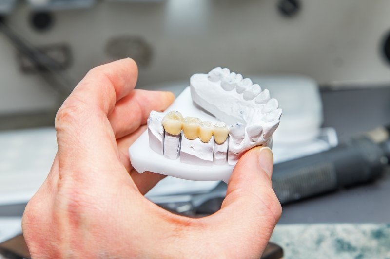 Dental bridge on model