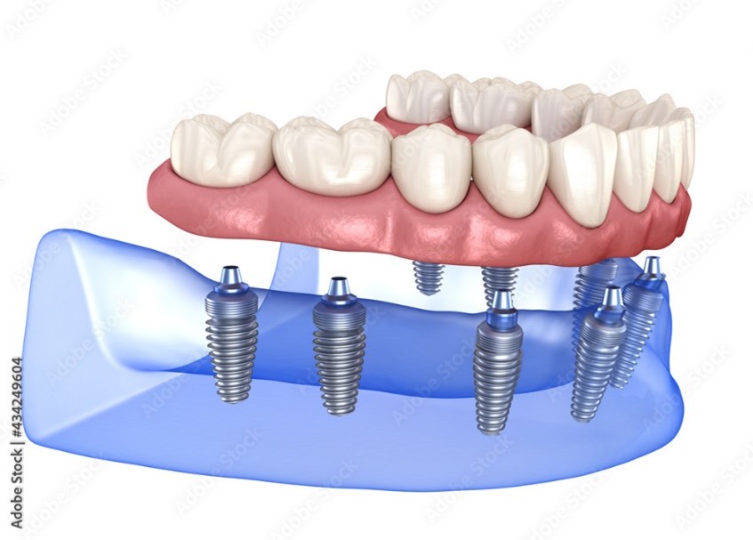 Image of implant-supported dentures.