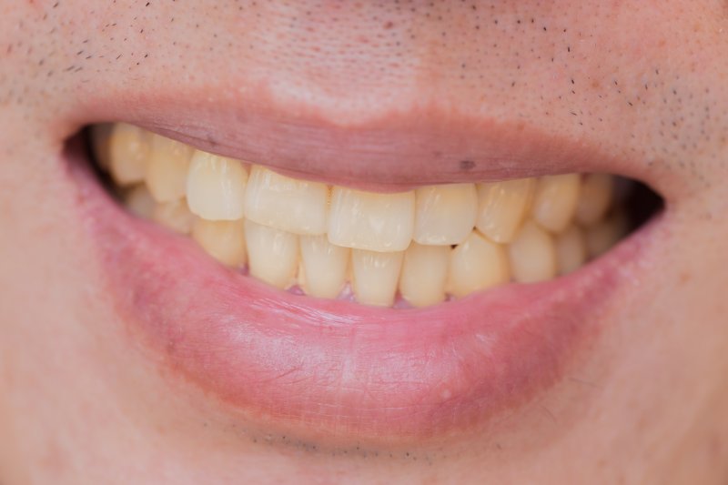 A close-up of extrinsic stains, one of the types of tooth stains
