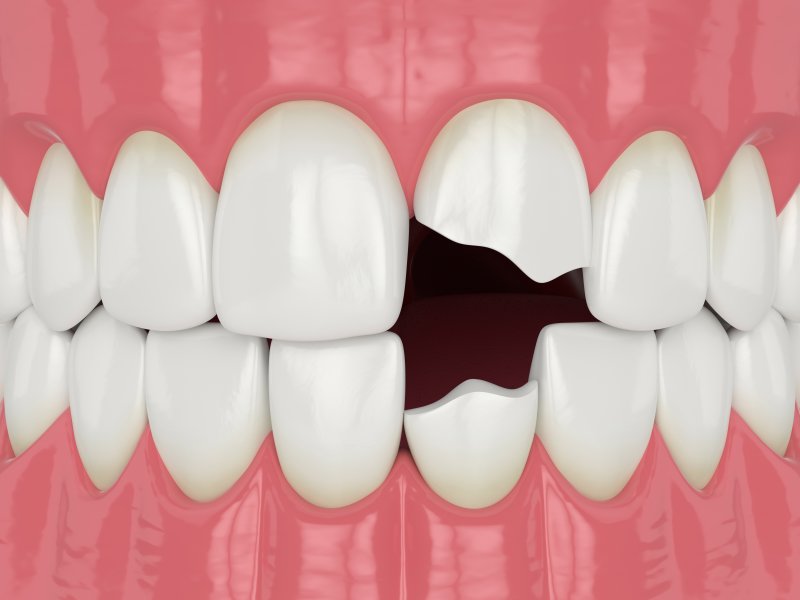 3-D Model of a chipped tooth
