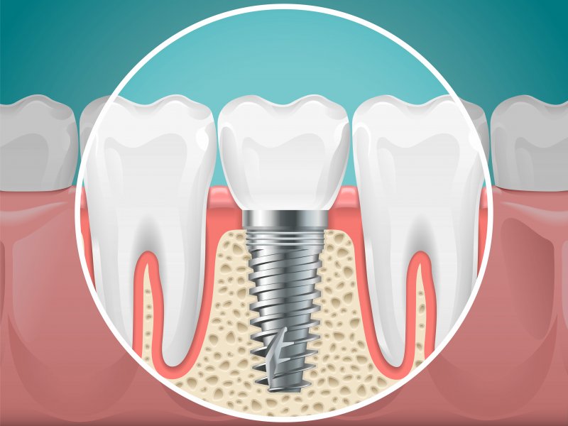 3-D Diagram of a dental implant