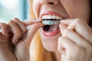 Woman putting on clear Invisalign aligners.