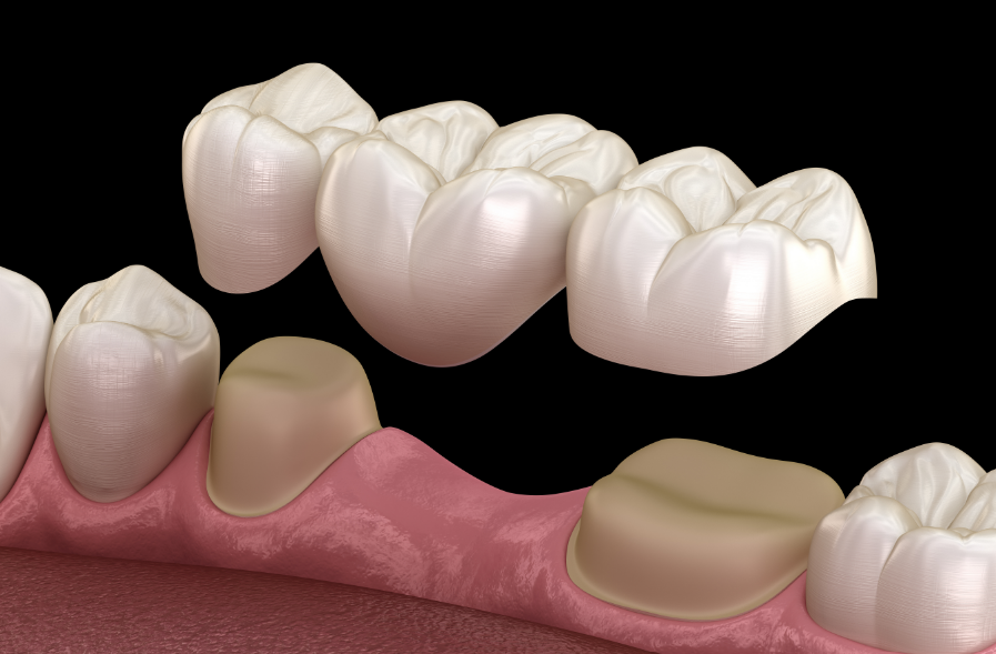3D image of a dental bridge