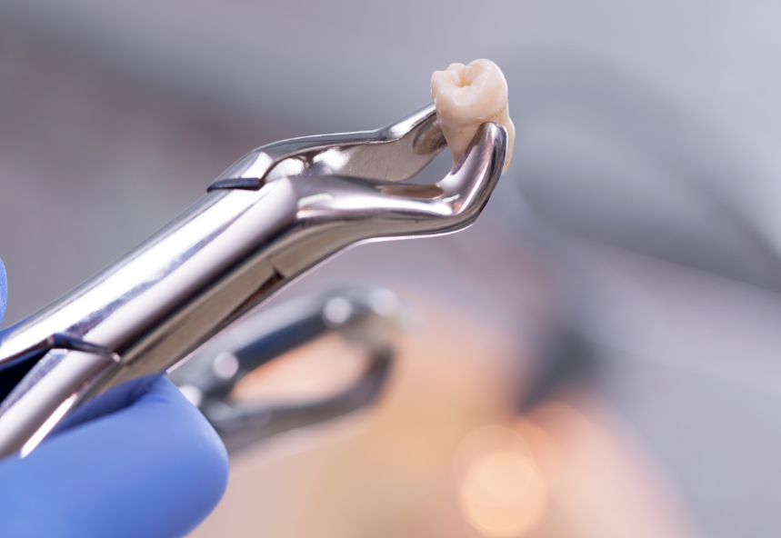 Extracted tooth on plyers