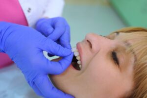 Dentist placing veneers on patient's front teeth.